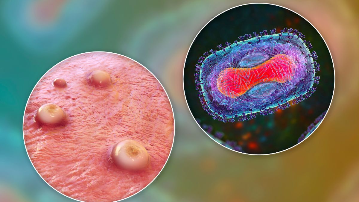 WHO công bố bệnh đậu mùa khỉ là ‘khẩn cấp toàn cầu’. Thông tin về bệnh đậu mùa khỉ tại TP Hồ Chí Minh